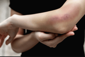 Why Alcohol Makes Your Body Bruise More Easily
